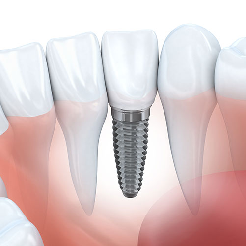 dental implants