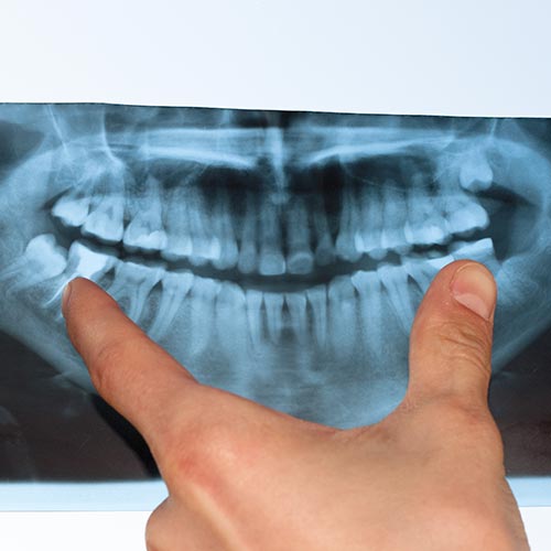 Dental X-rays